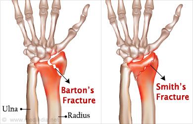 barton vs colles fracture barton vs colles fracture