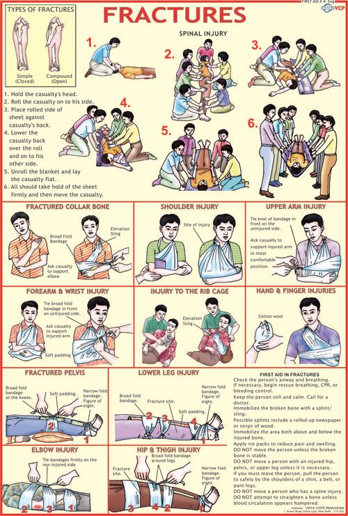 Fractures Chart First aid, Emergency medical, Medical education