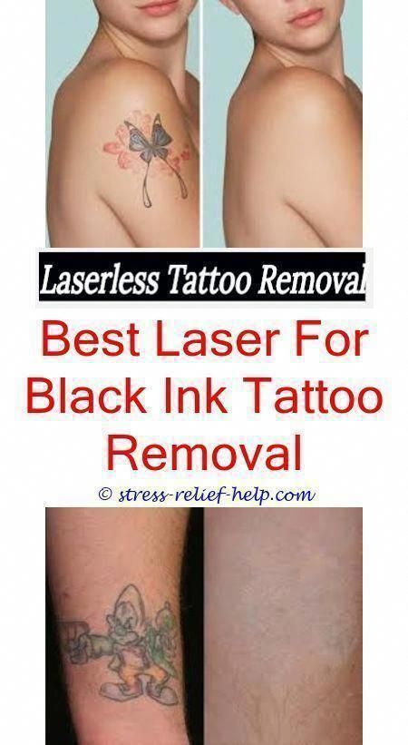 removable tattoo ink affordable tattoo removal near me - what is the most common...