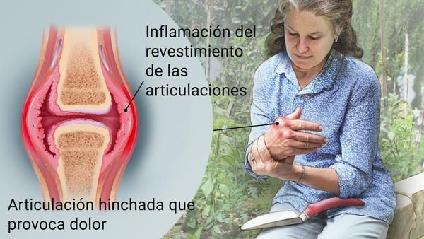 artritis inflamatoria cronica