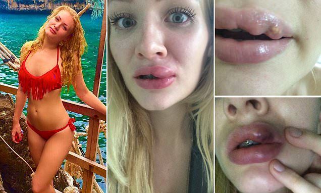 Die Lippen einer Frau färben sich blau, nachdem sie 50 Pfund Lippenfüller in einer thailändischen Klinik erhalten haben – Schönheit 1
