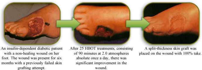 three stages of skin graft healing