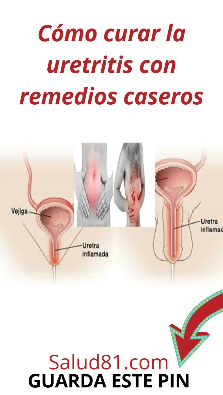 cura con láser de uretritis