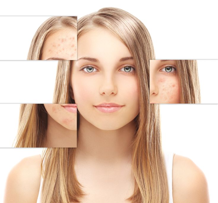How To Get Rid Of Facial Moles Naturally And Fast How To Get Rid Of Facial Moles Naturally And Fast