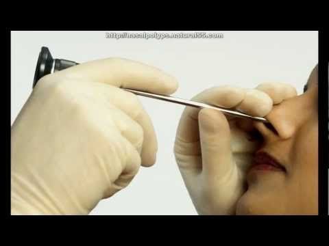 How To Get Rid Of Severe Nasal Congestion Naturally How To Get Rid Of Severe Nasal Congestion Naturally