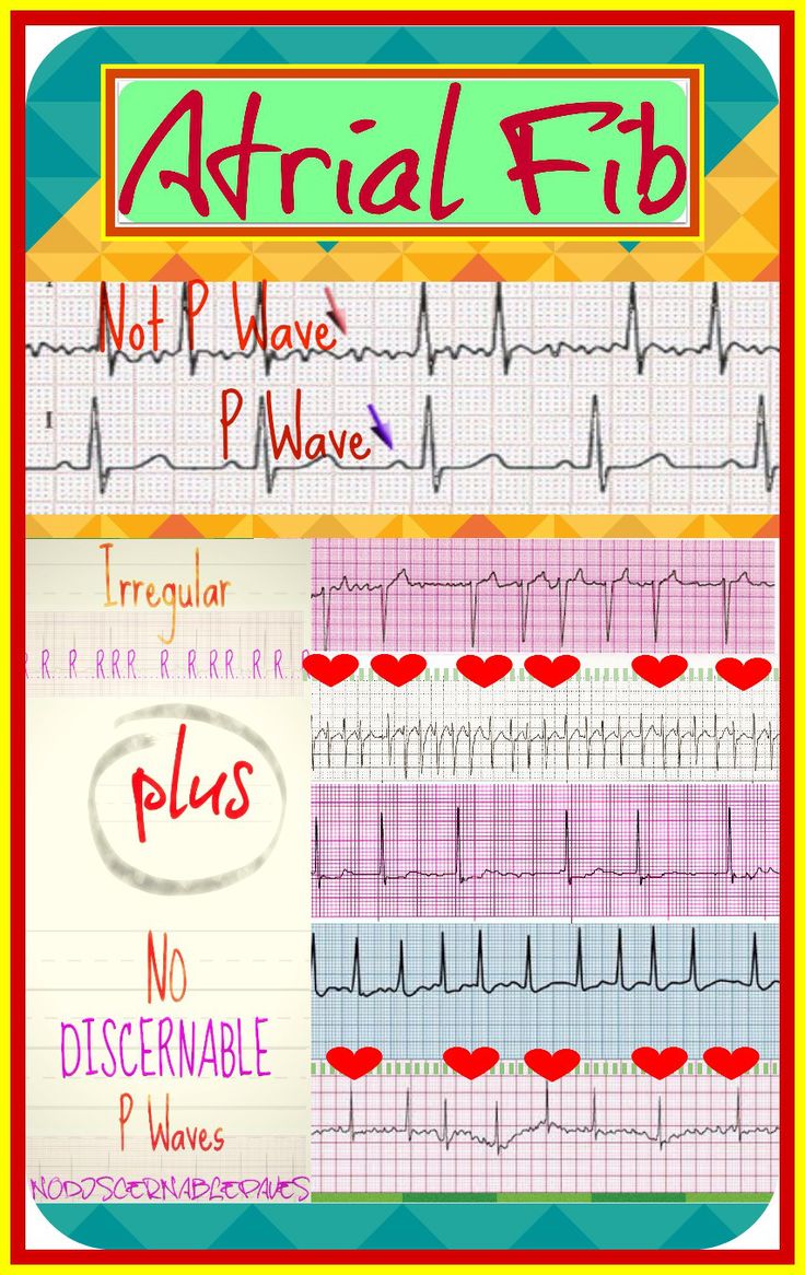 Cardizem Drip For Atrial Fib