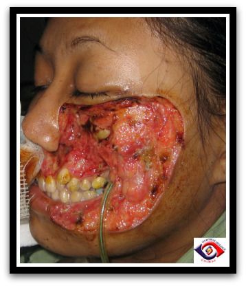 Strep throat wiki