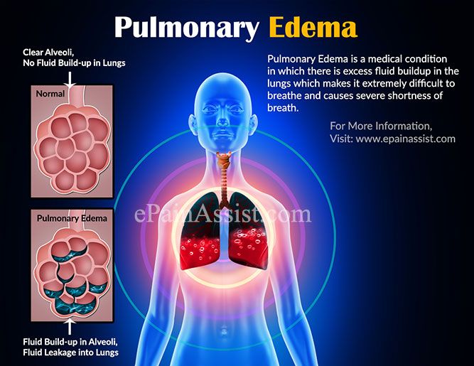 Edema ankle cpap machines