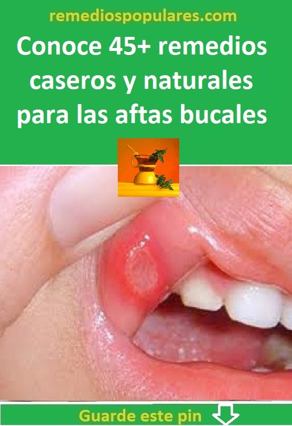 Remedios caseros para herpes bucal interno