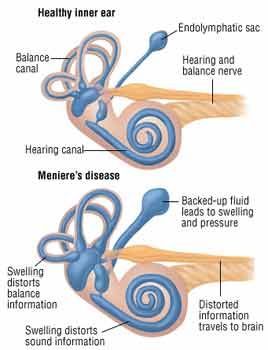 How To Make Ringing In Your Ear Go Away How To Make Ringing In Your Ear Go Away