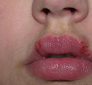 Fever Blister In Eye Natural Remedies Fever Blister In Eye Natural Remedies