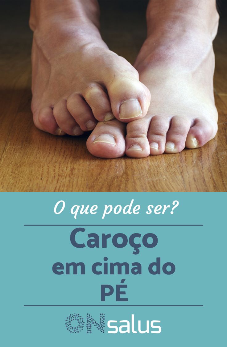 De das no nódulo pernas tratamento naturalmente varizes