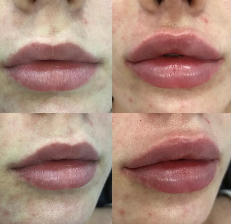 Check out our lip injection gallery! Dermal filler is made from Hylauronic Acid ...