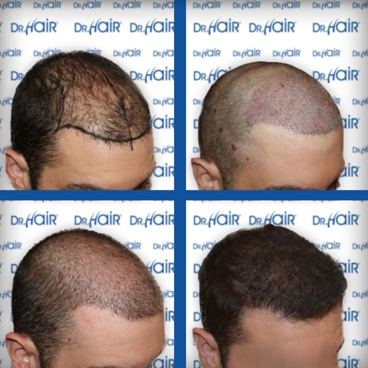 Dr Hair Hair Transplantation Turkey Sac Ekimi Dhi Choi Pens Sac Dr Hair Hair Transplantation Turkey Sac Ekimi Dhi Choi Pens Sac