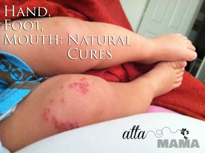 Hand Foot Mouth Disease Natural Treatment Hand Foot Mouth Disease Natural Treatment