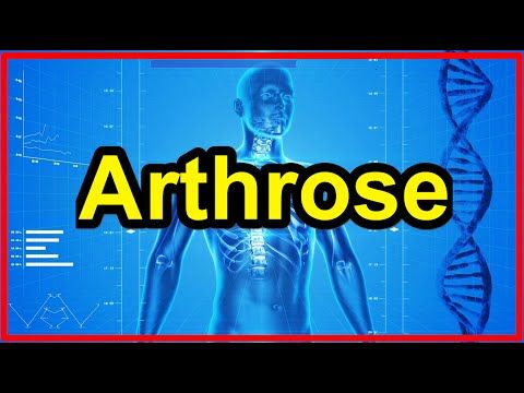 Ernährung bei Arthrose was hilft gegen Arthrose