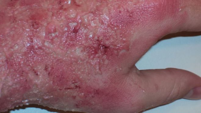 Natural Treatment Second Degree Burns Natural Treatment Second Degree Burns