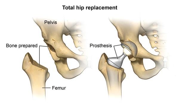 hip dysplasia surgery cost 44 best hip abduction brace images on braces acl knee and arthritis hip dysplasia surgery cost 44 best hip abduction brace images on braces acl knee and arthritis