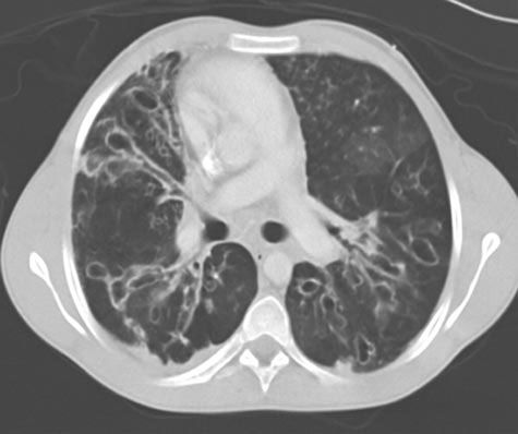 Natural Cure For Bronchiectasis Natural Cure For Bronchiectasis