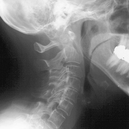 Neck Arthritis Cure Natural Neck Arthritis Cure Natural
