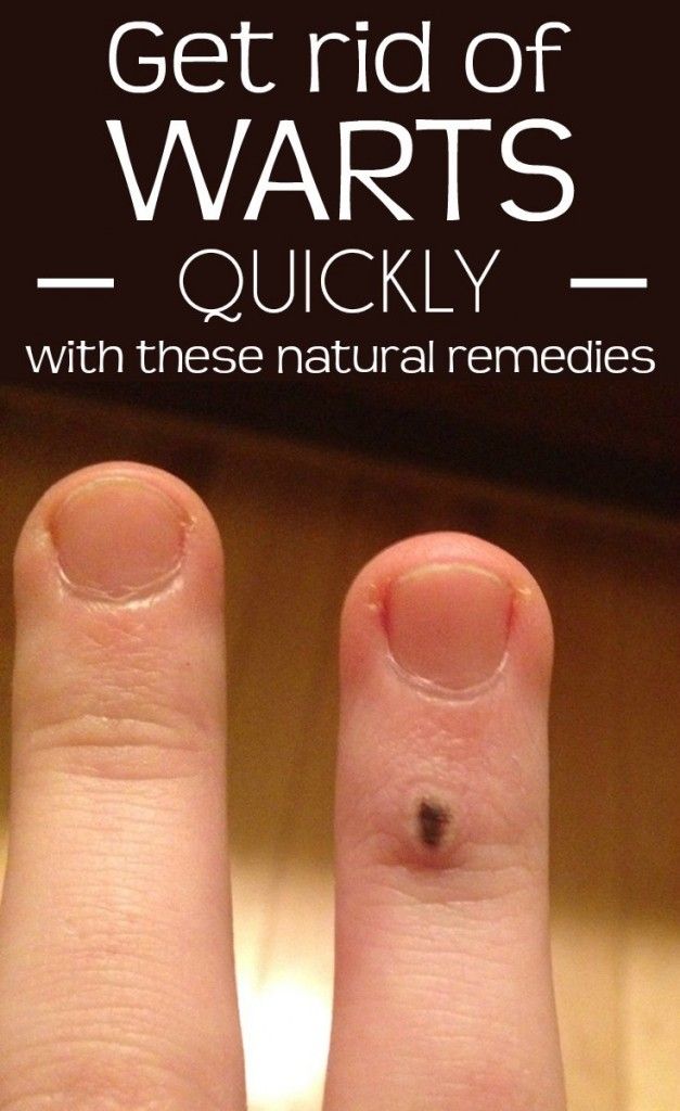How To Get Rid Of Filiform Warts Naturally How To Get Rid Of Filiform Warts Naturally