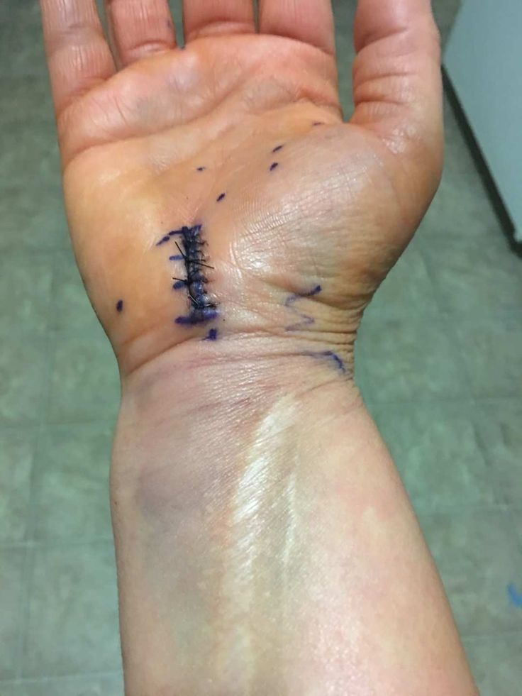 Carpal Tunnel Surgery Recovery 3 Months Later 24 7 Modern Mom carpal-tunnel-surgery-recovery-3-months-later-24-7-modern-mom