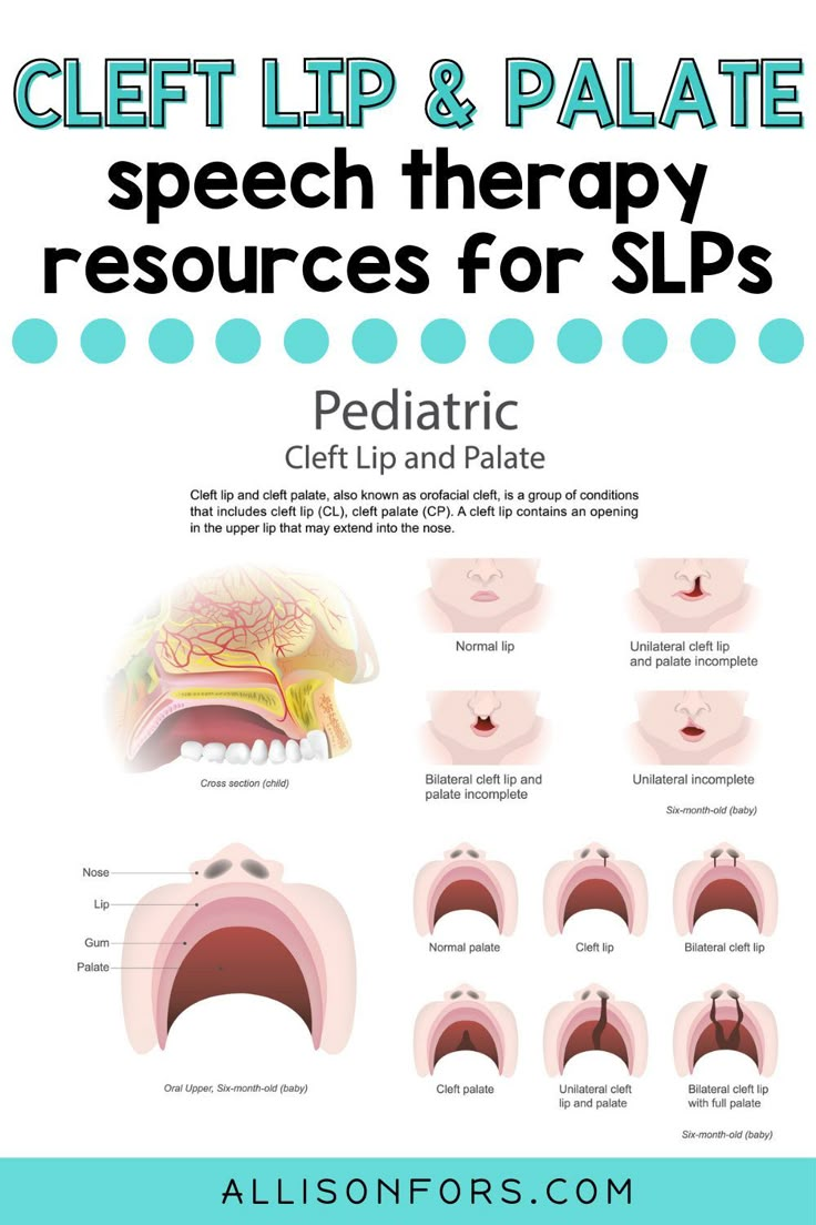 Speech therapy information about cleft palate and cleft lip. Discover activities, websites, resources, and research for cleft speech therapy intervention. Ideas, Cleft Palate Speech Therapy, Speech Language Pathology, Speech Language Pathologists, Speech Pathology, Speech And Language, Speech Therapy Tools, Speech Language Therapy, Cleft Lip And Palate