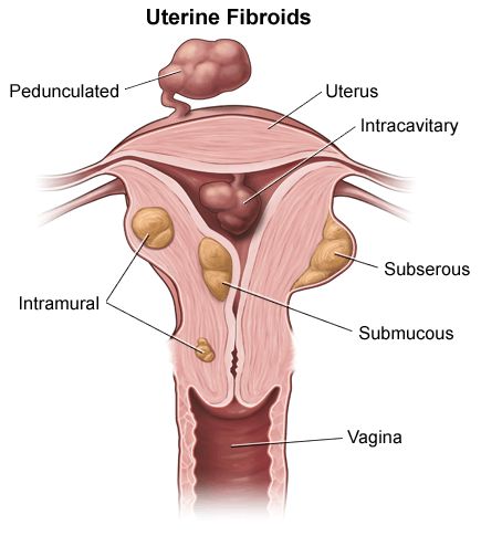 Natural Remedies For Dysfunctional Uterine Bleeding Natural Remedies For Dysfunctional Uterine Bleeding