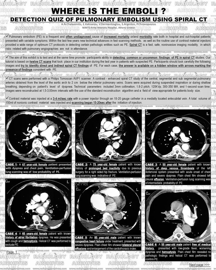 radiology archives where is emboli detection quiz radiology archives where is emboli detection quiz