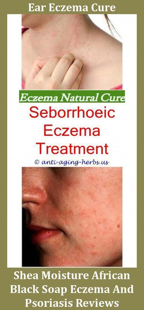 What Can Cause Eczema The Eczema Detox,mild case of eczema eczema and rheumatoid...