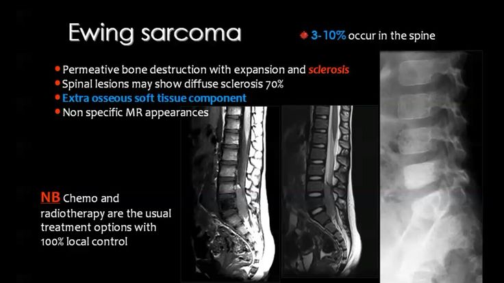 Dd of sclerotic vertebra are:- Metastasis Lymphoma Pagets Ewing