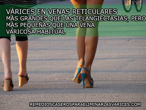 Tipos de varices
