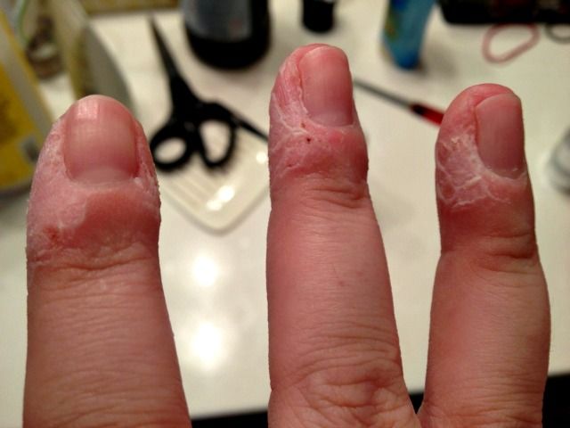Skin Peeling Around Ring Finger Skin Peeling Around Ring Finger