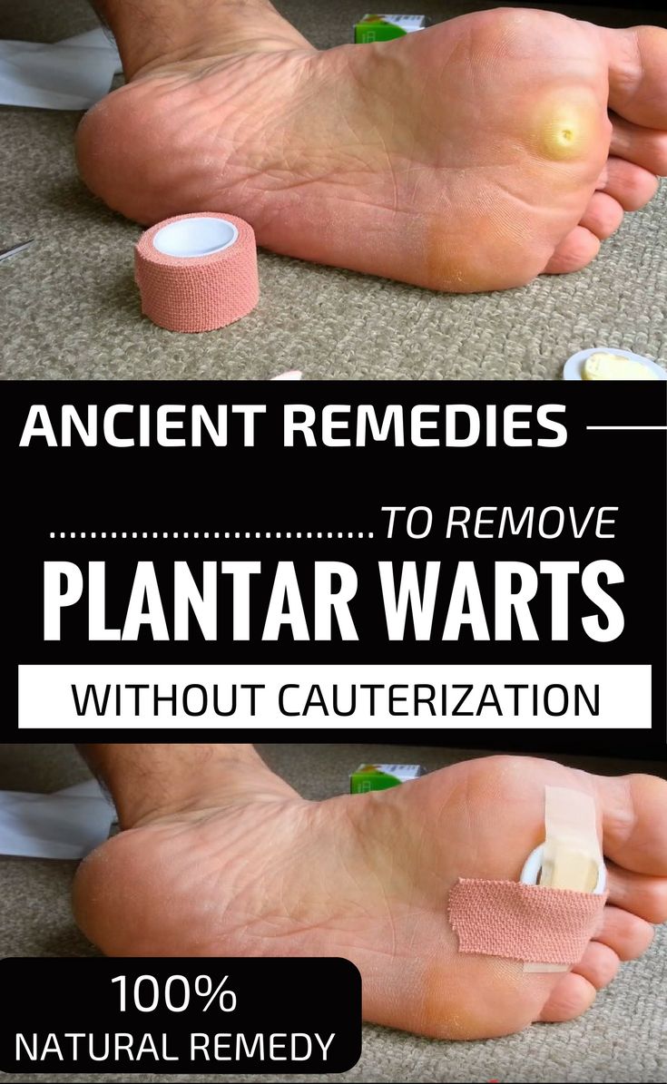Natural Remedies To Get Rid Of Plantar Warts Natural Remedies To Get Rid Of Plantar Warts