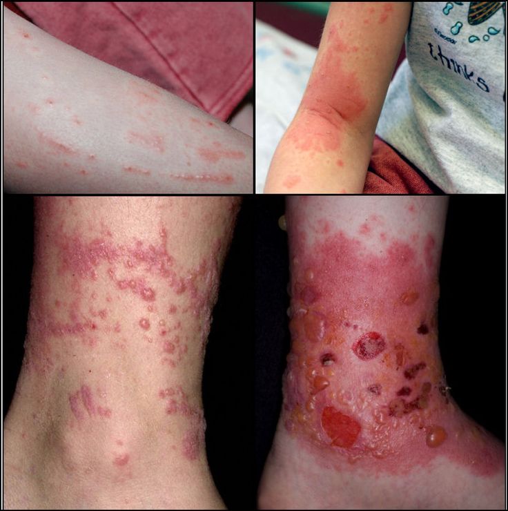 How to Identify Poison Ivy, Oak, and Sumac | Poison ivy rash, Sumac