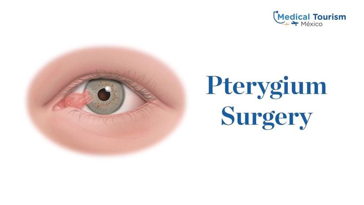 Pterygium surgery procedure Medical Tourism Mexico
