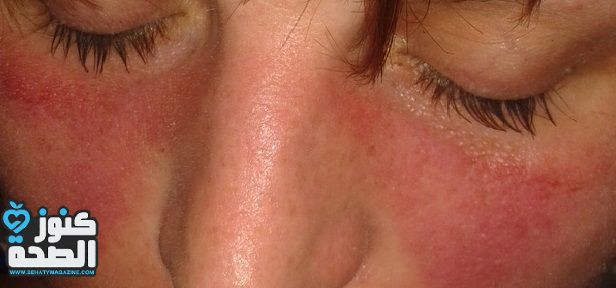 هل يمكن الشفاء من مرض الذئبة الحمراء Lupus