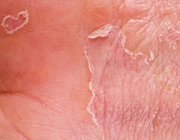 Eczema On Palms Natural Treatment Eczema On Palms Natural Treatment