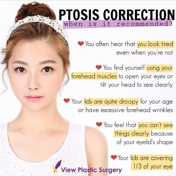 Ptosiscorrection Eyelidsurgery Ptosis Ptosissurgery Viewclinic Ptosiscorrection Eyelidsurgery Ptosis