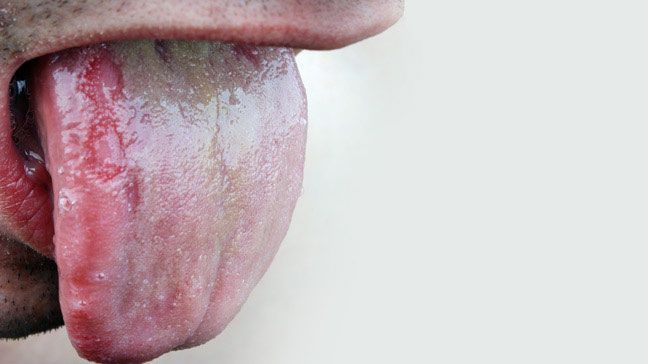 ¿Cómo consigo una infección de levadura en mi piel?