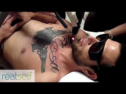 19 best tired of that tattoo see the results of tattoo removal 19 best tired of that tattoo see the results of tattoo removal