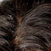 Mon Astuce Efficace et Naturelle Contre les Pellicules.