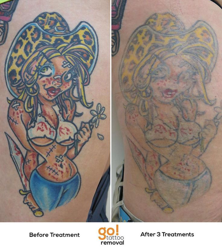 829 best tattoo removal in progress images on pinterest 829 best tattoo removal in progress images on pinterest