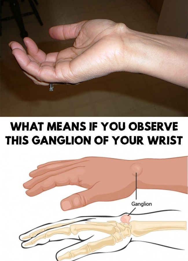What Means If You Observe This Ganglion Of Your Wrist