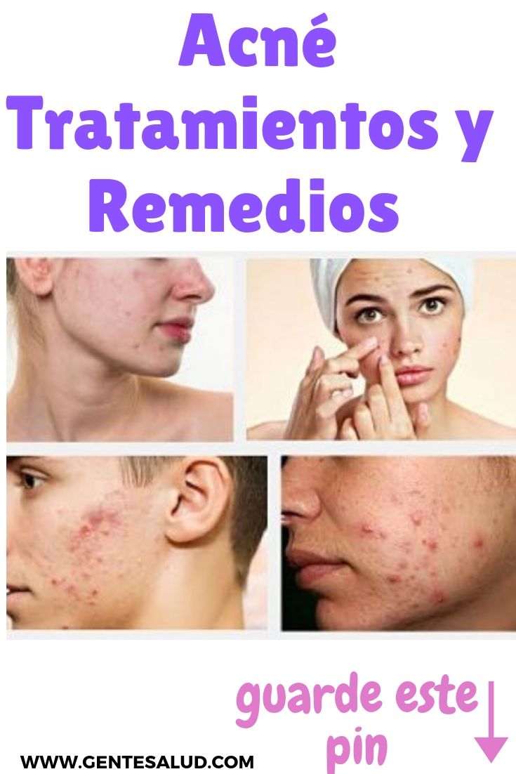 tratamiento para curar el acne dela cara