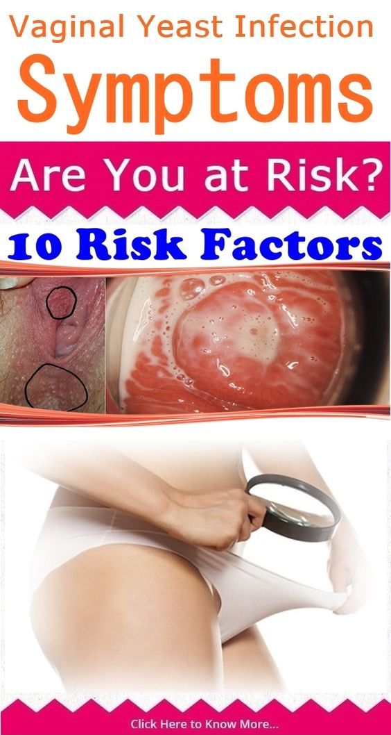 Yeast Infection Vagina Yeast Infection Vagina