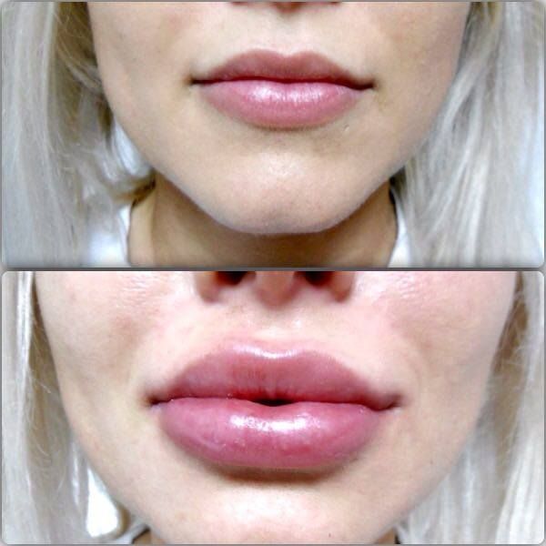 acid hialuronic buze 2 ml