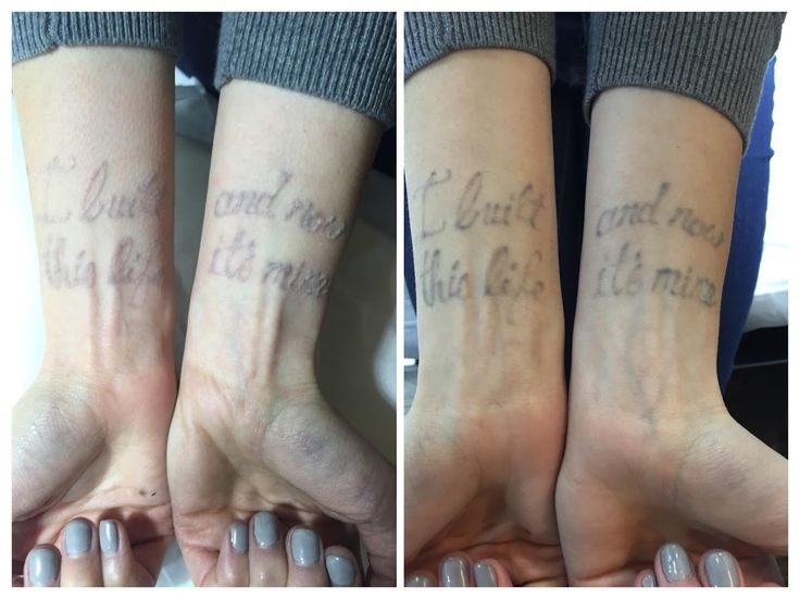 after one session the writing is disappearing tattoo removal at after one session the writing is disappearing tattoo removal at