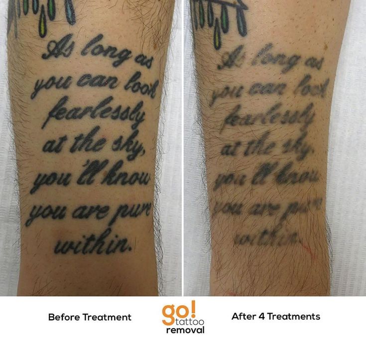 827 best tattoo removal in progress images on pinterest 827 best tattoo removal in progress images on pinterest
