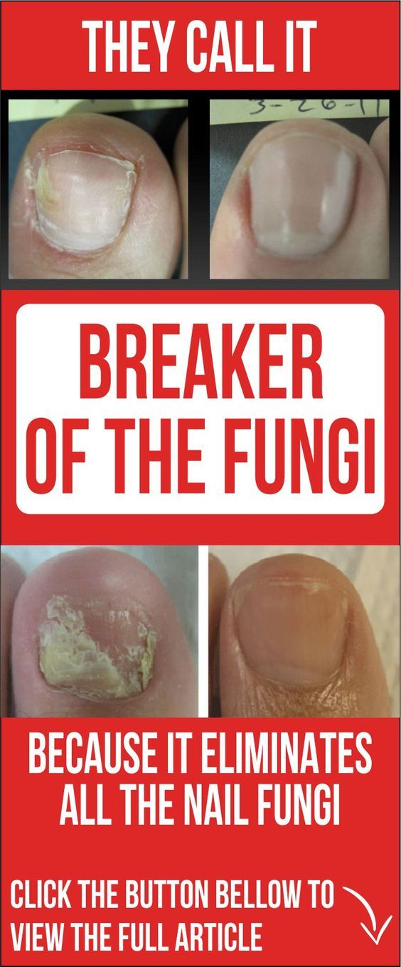 Http Www Naturallivingideas Com Top Natural Remedies For Toenail Fungus Http Www Naturallivingideas Com Top Natural Remedies For Toenail Fungus